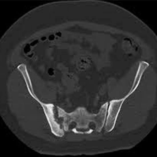 CT Scan Bilateral Sacroiliac Joint